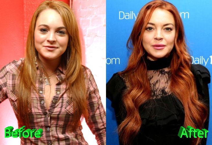 Lindsay Lohan Before and After Surgery Procedure