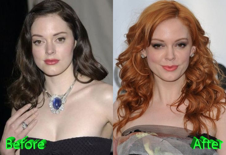Rose McGowan Before and After Cosmetic Surgery