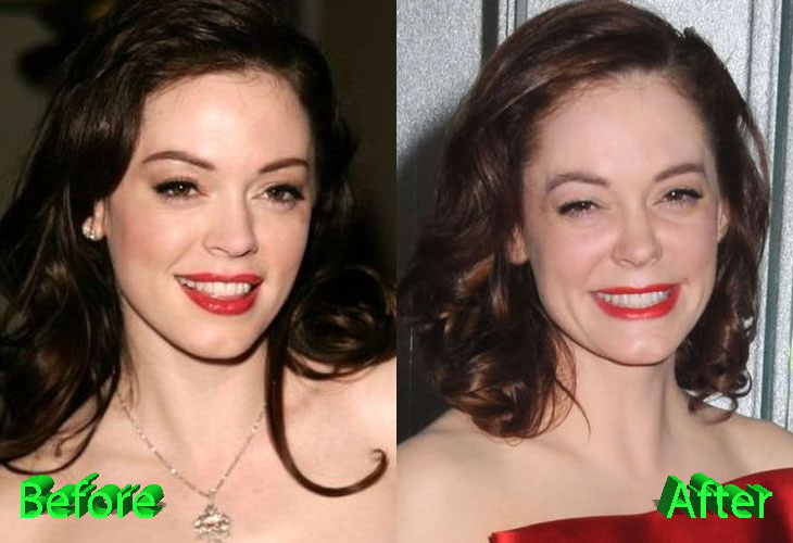 Rose Mcgowan Plastic Surgery: You Be the Judge