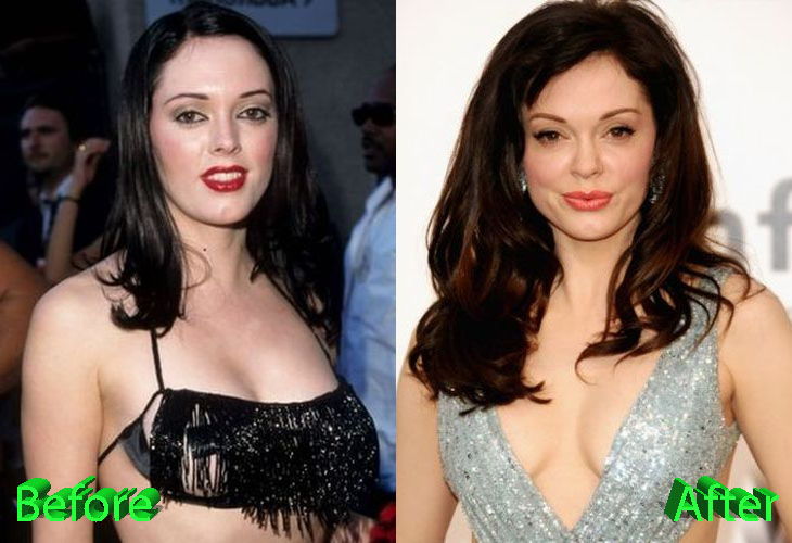 Rose McGowan Before and After Plastic Surgery