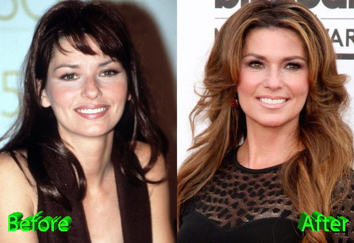 Shania Twain Before and After Cosmetic Surgery