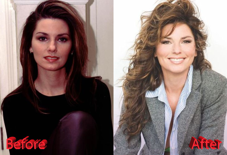 Shania Twain Before and After Plastic Surgery