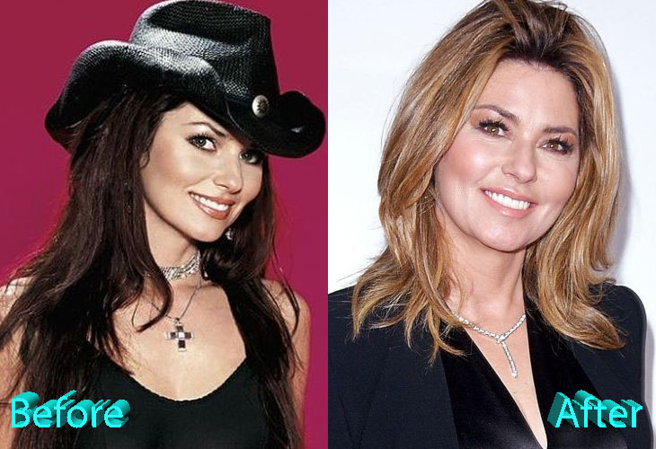 Shania Twain Before and After Surgery Procedure