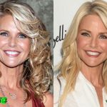 christie brinkley before and after cosmetic surgery 150x150