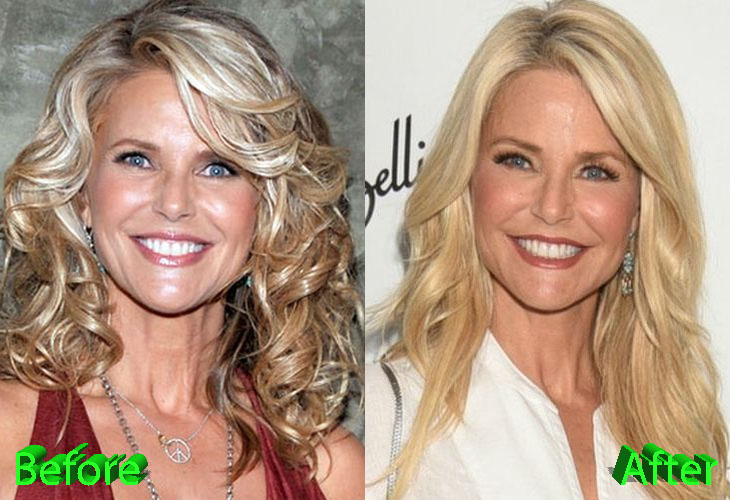 christie brinkley before and after cosmetic surgery