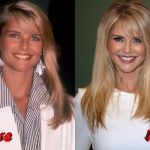 christie brinkley before and after facelift surgery 150x150