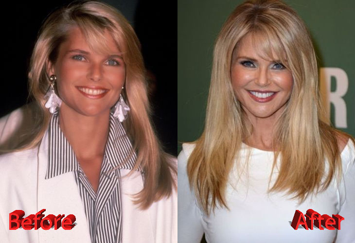 christie brinkley before and after facelift surgery