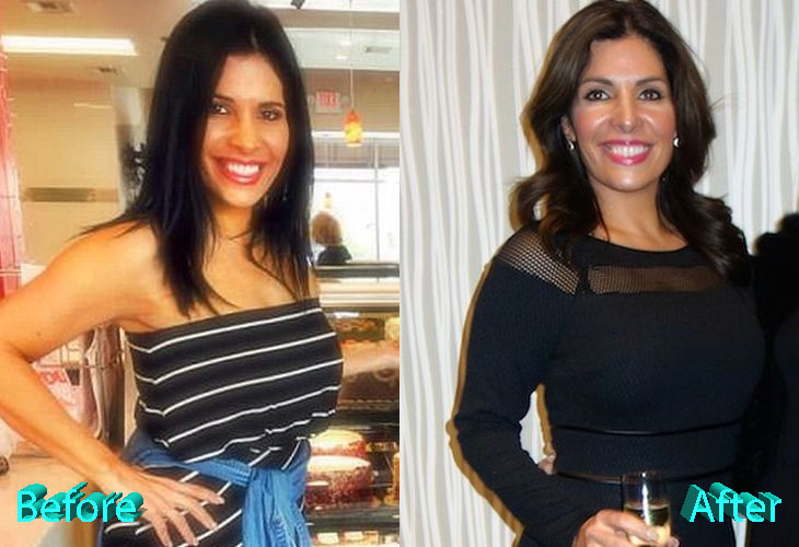 Claudia Sierra Before and After Cosmetic Surgery