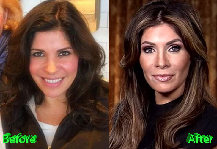 Claudia Sierra Before and After Plastic Surgery