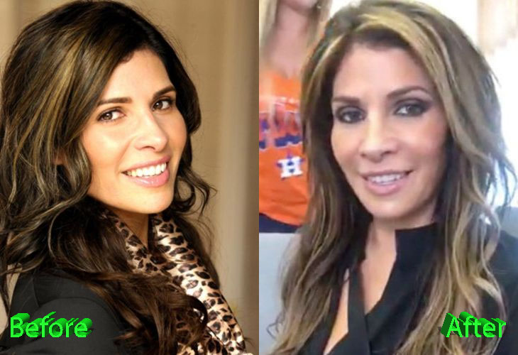 Claudia Sierra Before and After Surgery Procedure