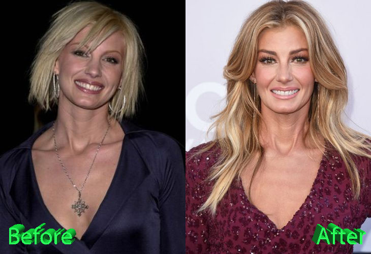 Faith Hill Before and After Plastic Surgery