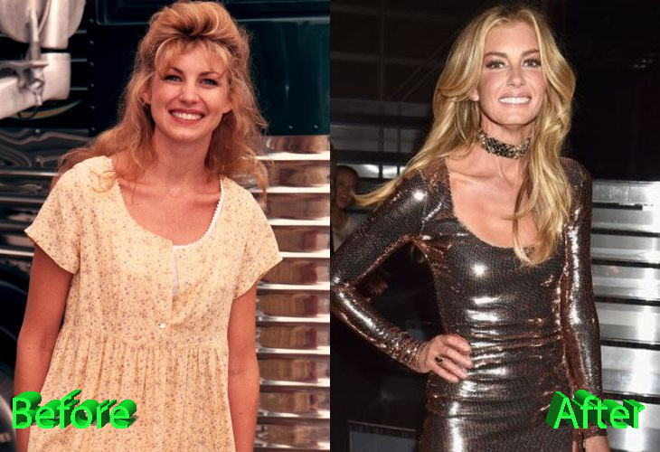 Faith Hill Before and After Surgery Procedure