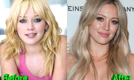 Hilary Duff Plastic Surgery: Nothing To Hide For Lovely Actress