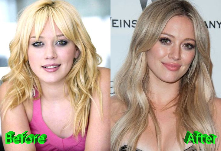 Hilary Duff Plastic Surgery: Nothing To Hide For Lovely Actress