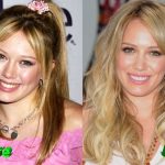 Hilary Duff Before and After Plastic Surgery 150x150