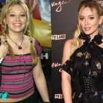 Hilary Duff Before and After Surgery Procedure 150x150