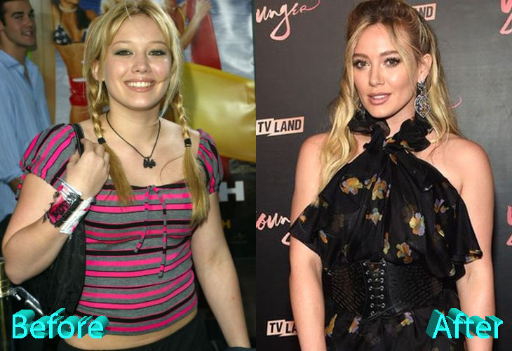 Hilary Duff Before and After Surgery Procedure