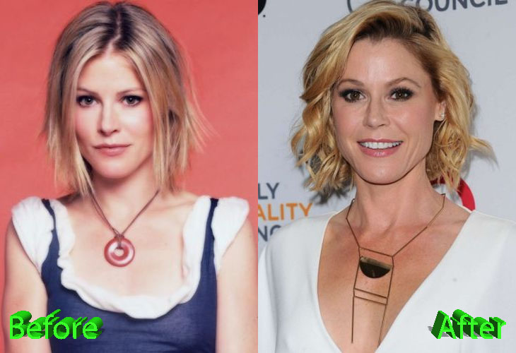 Julie Bowen Before and After Cosmetic Surgery