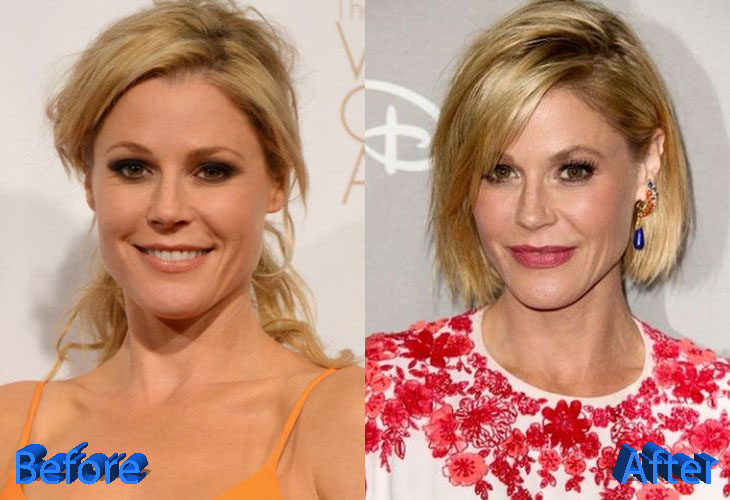 Julie Bowen Before and After Plastic Surgery