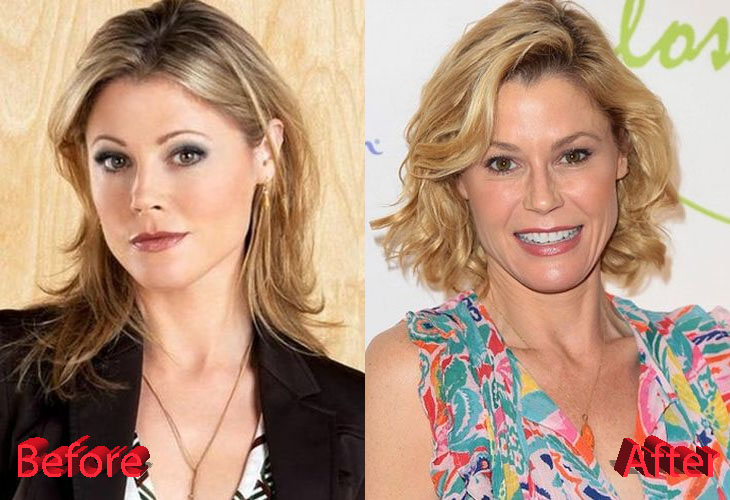 Julie Bowen Before and After Surgery Procedure