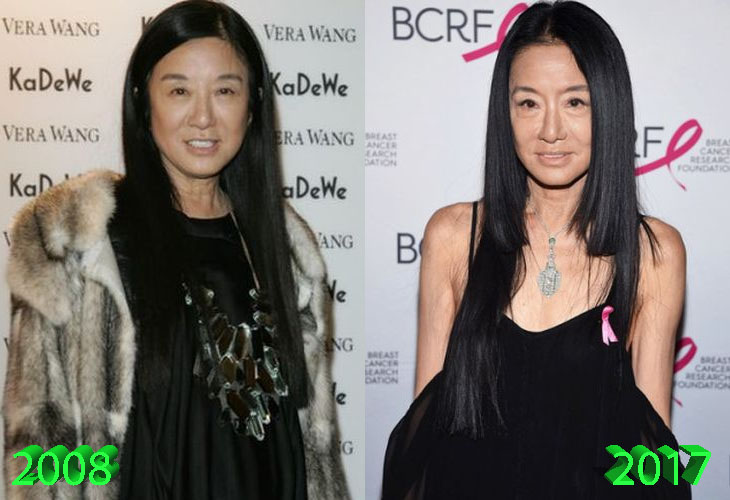 Vera Wang Before and After Surgery Procedure