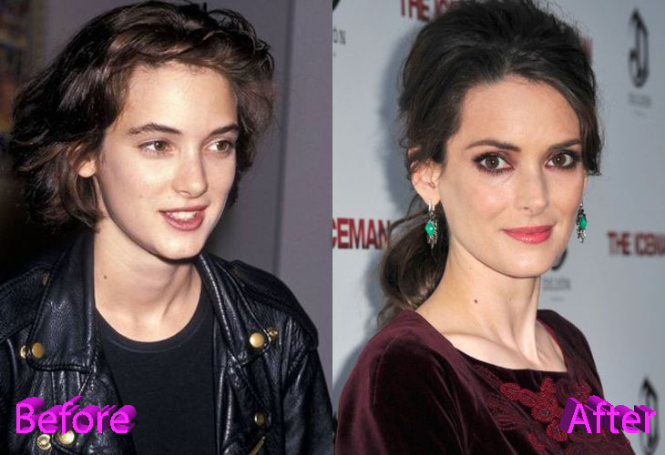 Winona Ryder Before and After Cosmetic Surgery