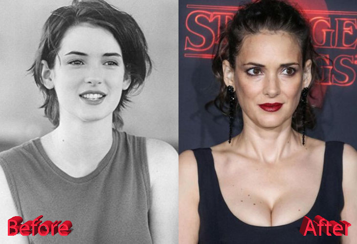 Winona Ryder Before and After Plastic Surgery