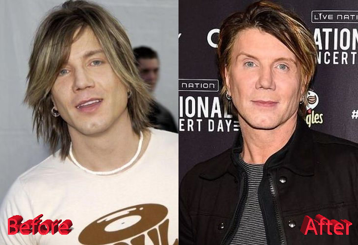 John Rzeznik Before and After Plastic Surgery