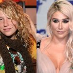 Kesha Before and After Cosmetic Surgery 150x150