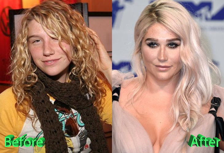 Kesha Before and After Cosmetic Surgery