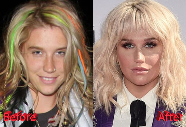 Kesha Before and After Plastic Surgery