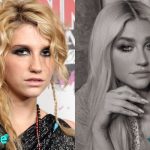 Kesha Before and After Surgery Procedure 150x150