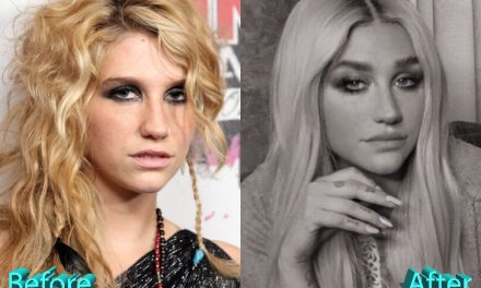 Kesha Plastic Surgery: From Duckling To Swan, Or Not?