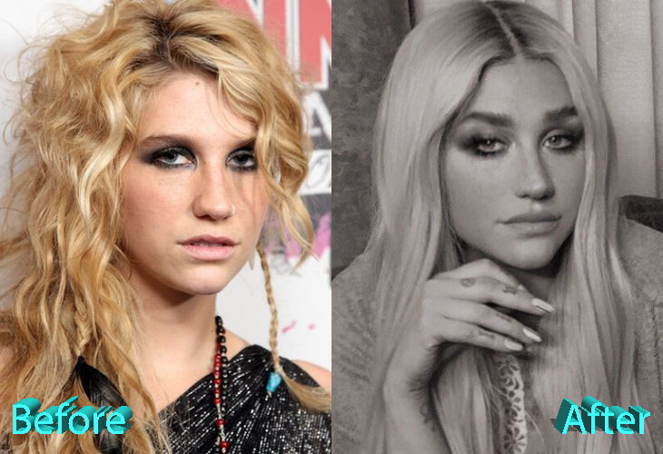 Kesha Plastic Surgery: From Duckling To Swan, Or Not?