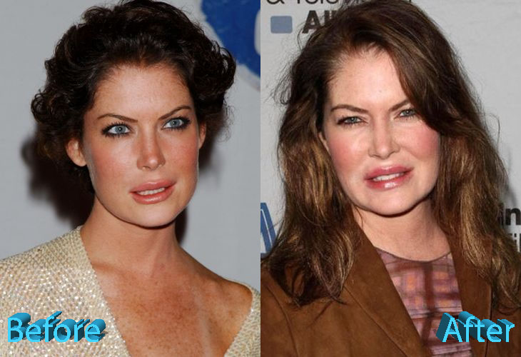 Lara Flynn Boyle Before and After Multiple Plastic Surgeries