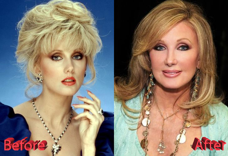 Morgan Fairchild Before and After Cosmetic Surgery
