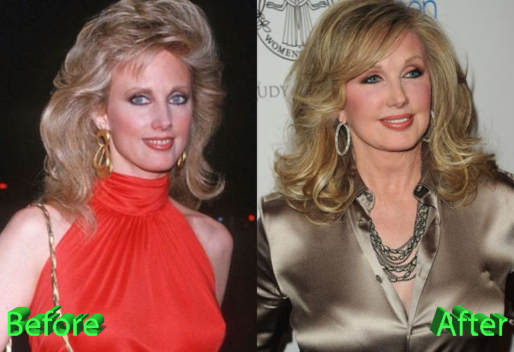 Morgan Fairchild Before and After Plastic Surgery