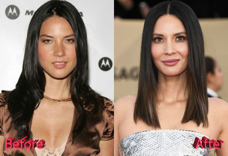 Olivia Munn Before and After Cosmetic Surgery