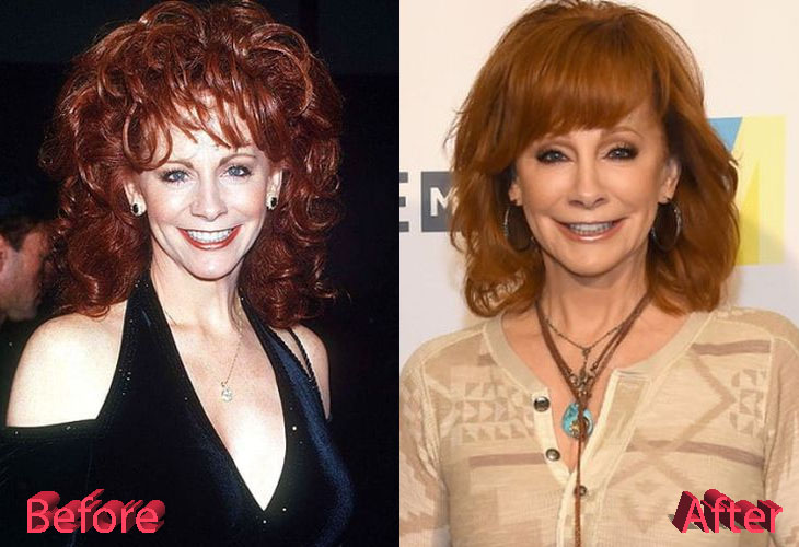 Reba McEntire Plastic Surgery Looking Just Right
