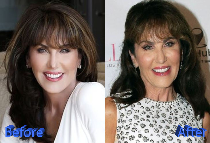 Robin McGraw Before and After Plastic Surgery