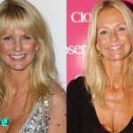 Ulrika Jonsson Before and After Cosmetic Surgery 150x150