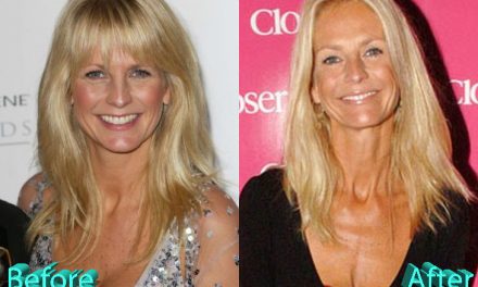 Ulrika Jonsson Plastic Surgery –Did It Improve Or Degrade Her Looks?