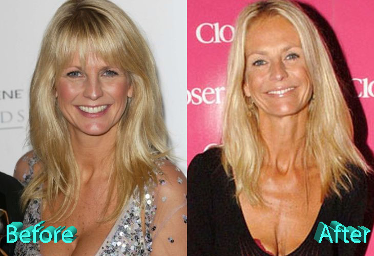 Ulrika Jonsson Plastic Surgery –Did It Improve Or Degrade Her Looks?