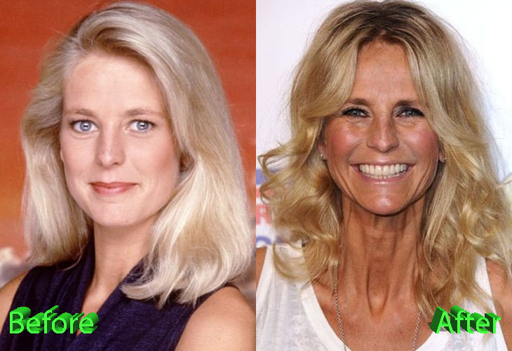 Ulrika Jonsson Before and After Plastic Surgery