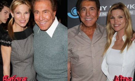 Andrea and Steve Wynn Plastic Surgery : Not the Best of Ideas
