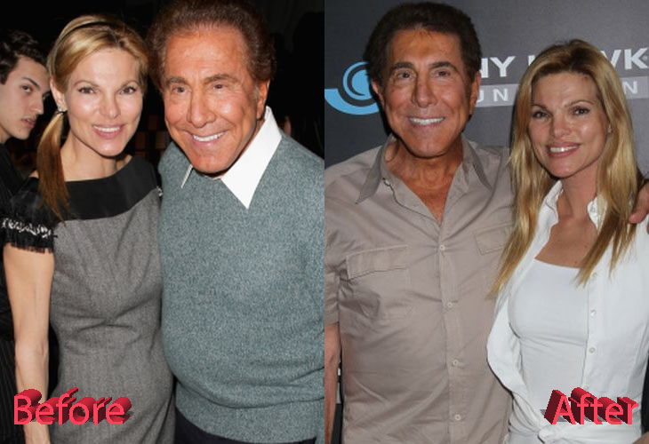 Andrea and Steve Wynn Plastic Surgery : Not the Best of Ideas