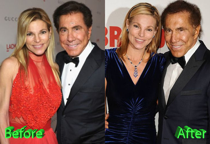 Andrea and Steve Wynn Before and After Plastic Surgery