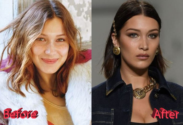 Bella hadid nose job