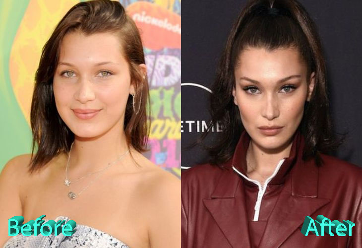 Bella Hadid Before and After Plastic Surgery