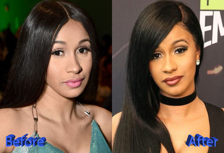 Cardi B Before and After Cosmetic Surgery - Plastic Surgery Mistakes.